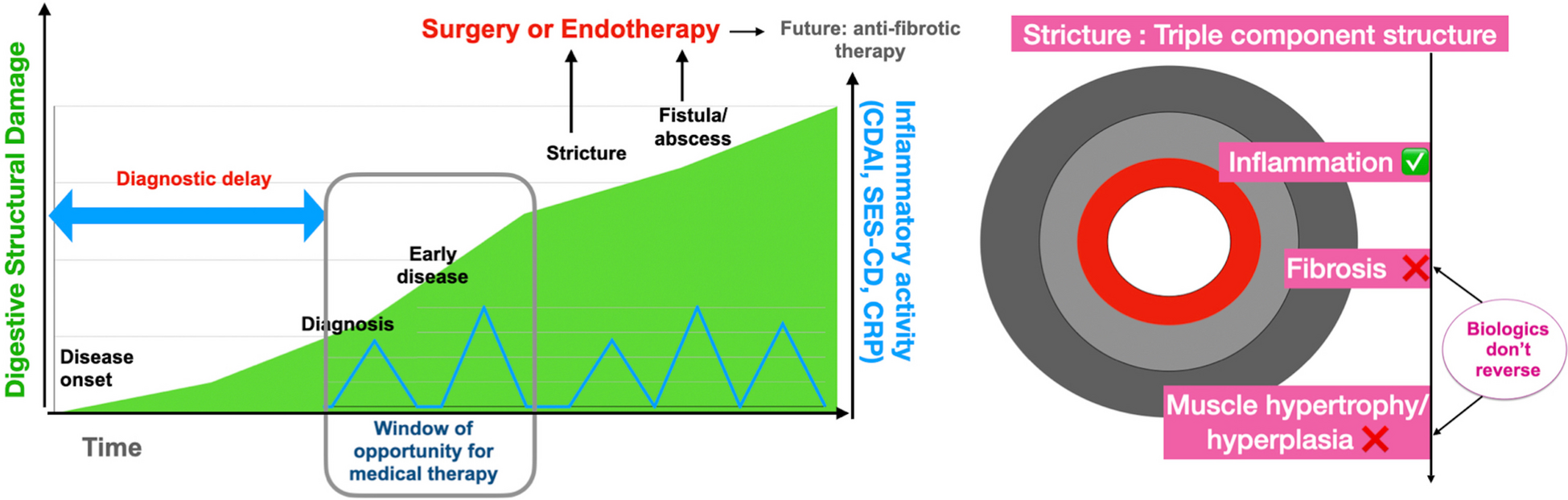 Endoscopic stricture management in inflammatory bowel disease: Present and future