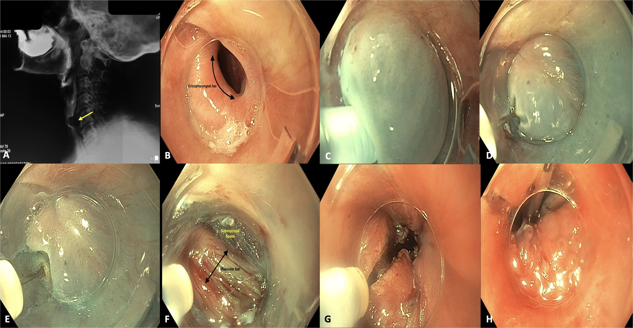 Cricopharyngeal POEM: A minimally invasive option for cricopharyngeal achalasia and bar