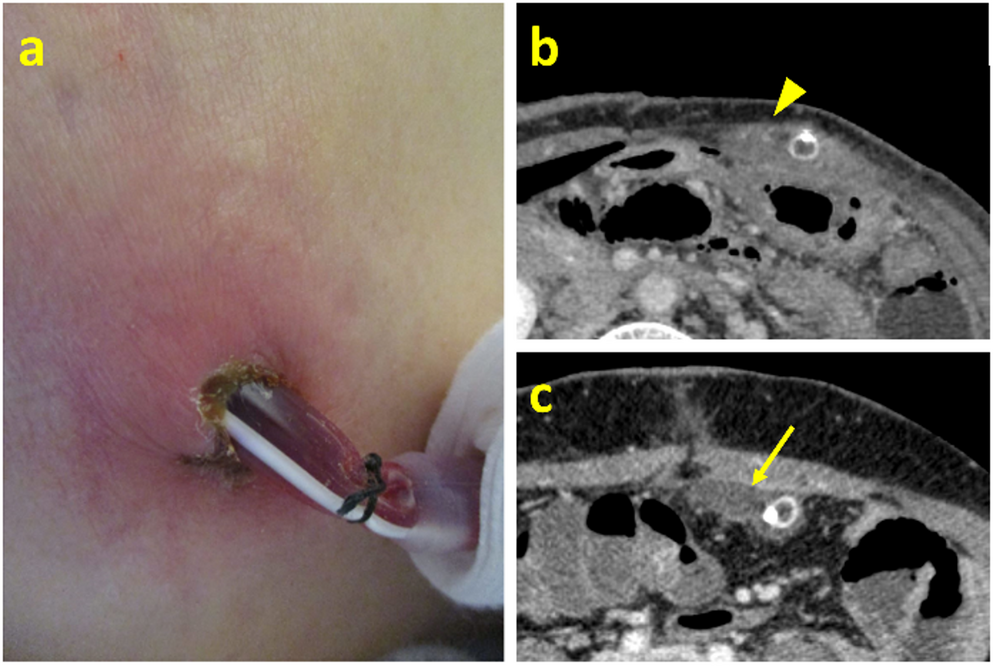Analysis of retrograde infection of prophylactic pelvic drains in rectal cancer surgery: a retrospective cohort study