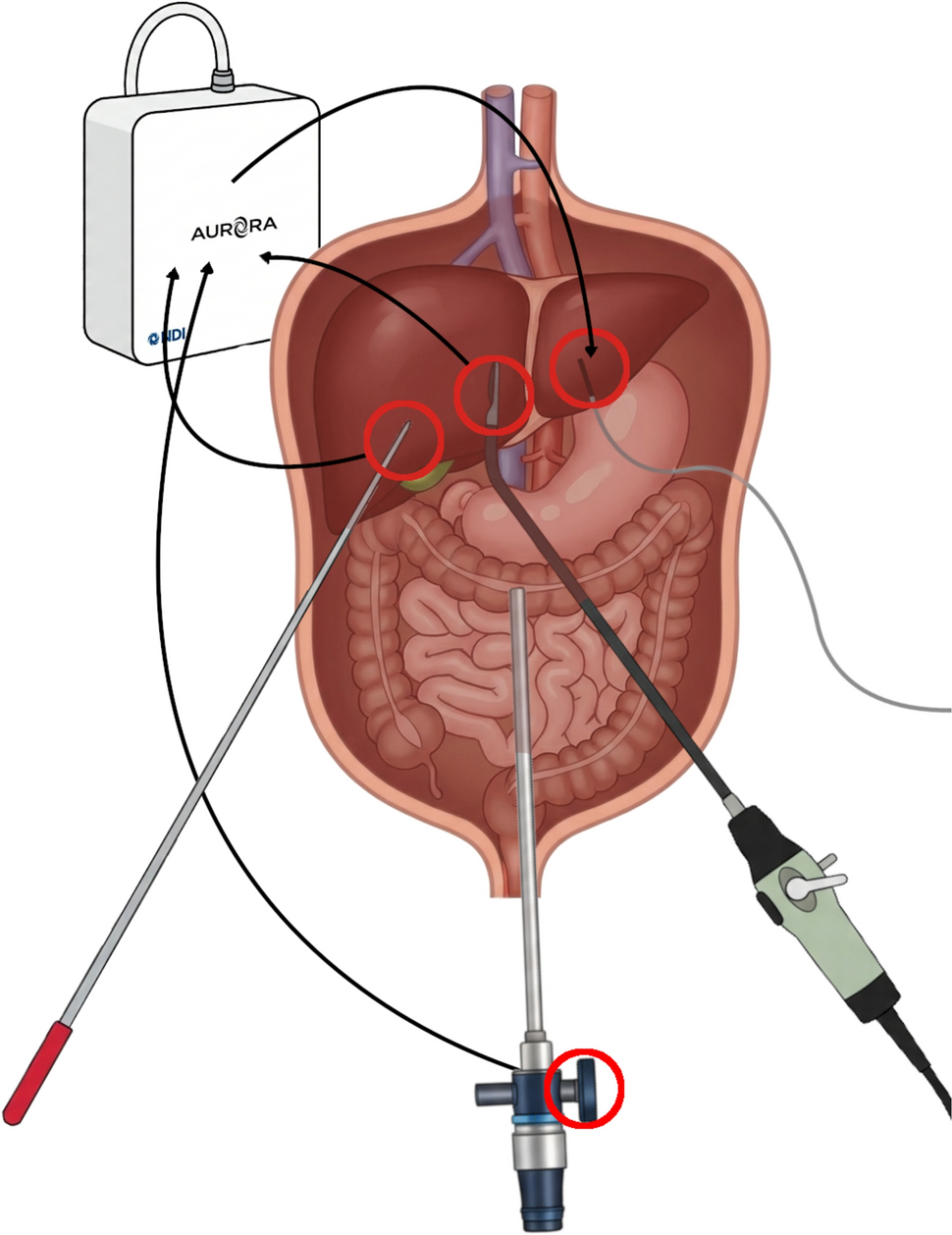 Toward augmented reality in laparoscopic liver surgery using electromagnetic tracking: a clinical feasibility study