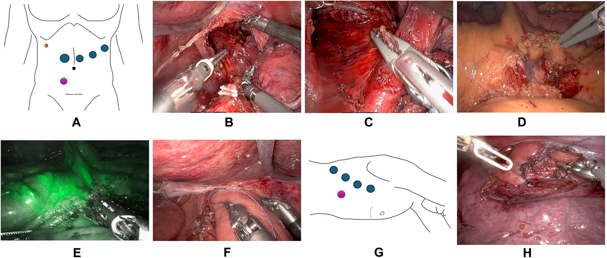 Fully robotic extended total gastrectomy with transthoracic long Roux limb reconstruction