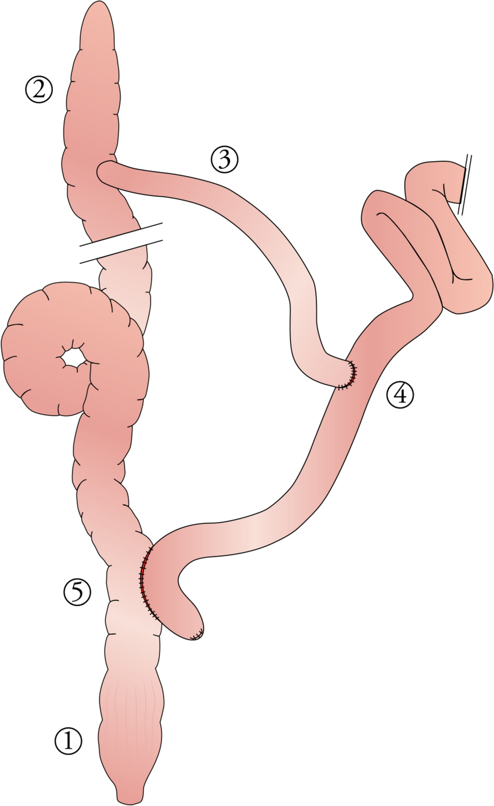 Balloon dilation versus endoscopic stricturotomy in the treatment of Crohn’s anastomotic stricture: experimental randomized study