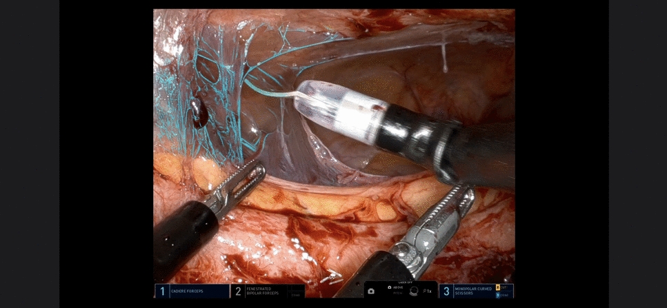 The first reported case using real-time artificial intelligence with single-port robotics for colorectal surgery