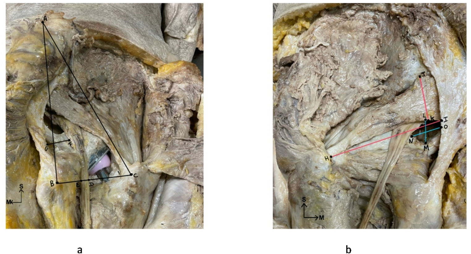 Anatomical variations in the relationship between the sciatic nerve and the piriformis muscle: clinical implications