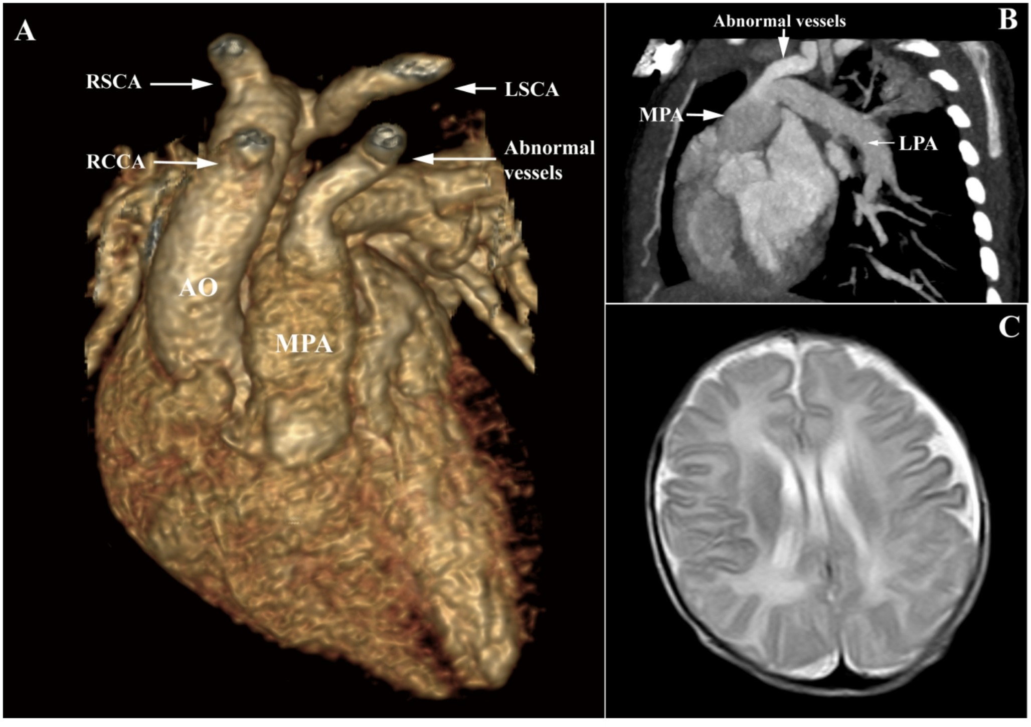 Isolated left common carotid artery: steal syndrome and neurological complications