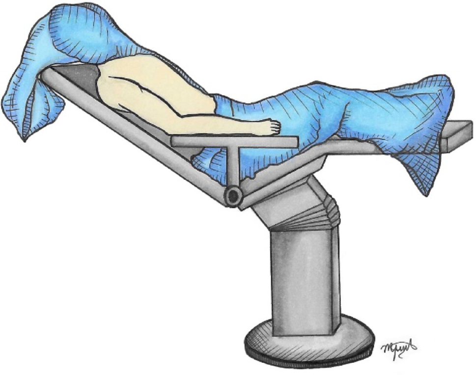 The long head of the biceps tendon as a pedicled autograft for acromioclavicular joint reconstruction: development of an arthroscopic technique