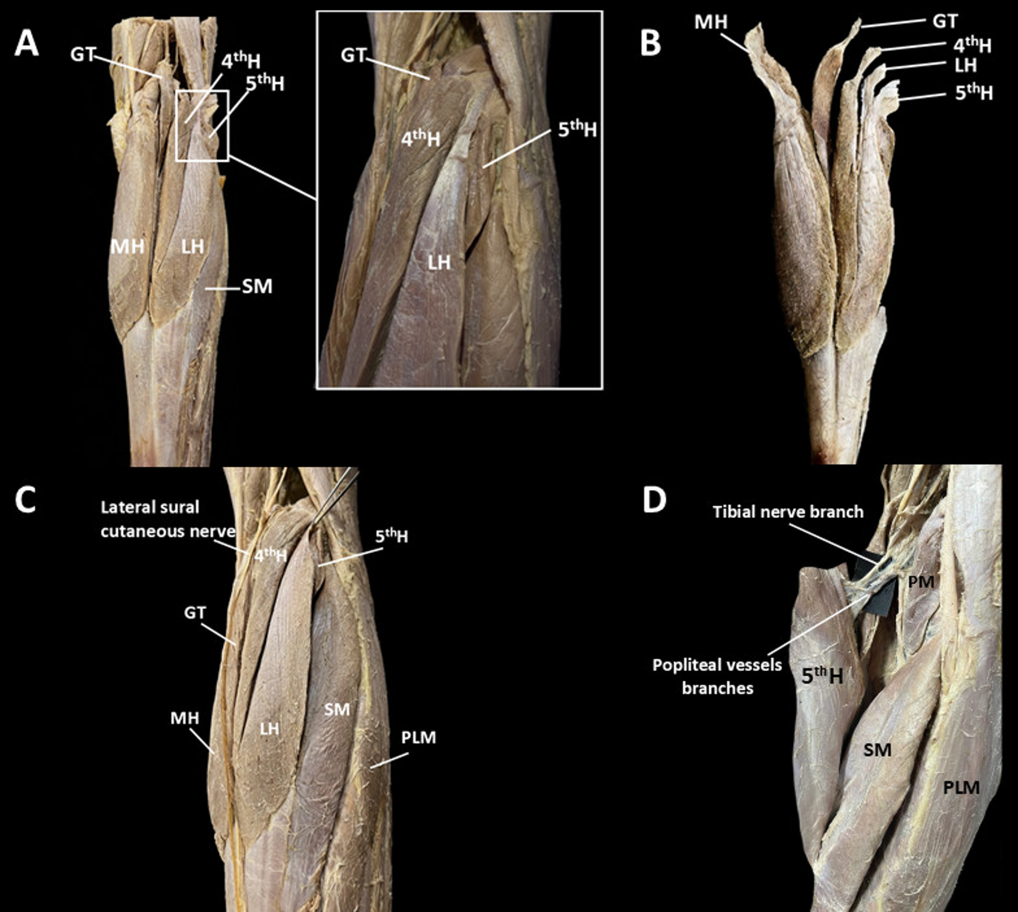 Anatomical insights into a five-bellied gastrocnemius muscle: a case report