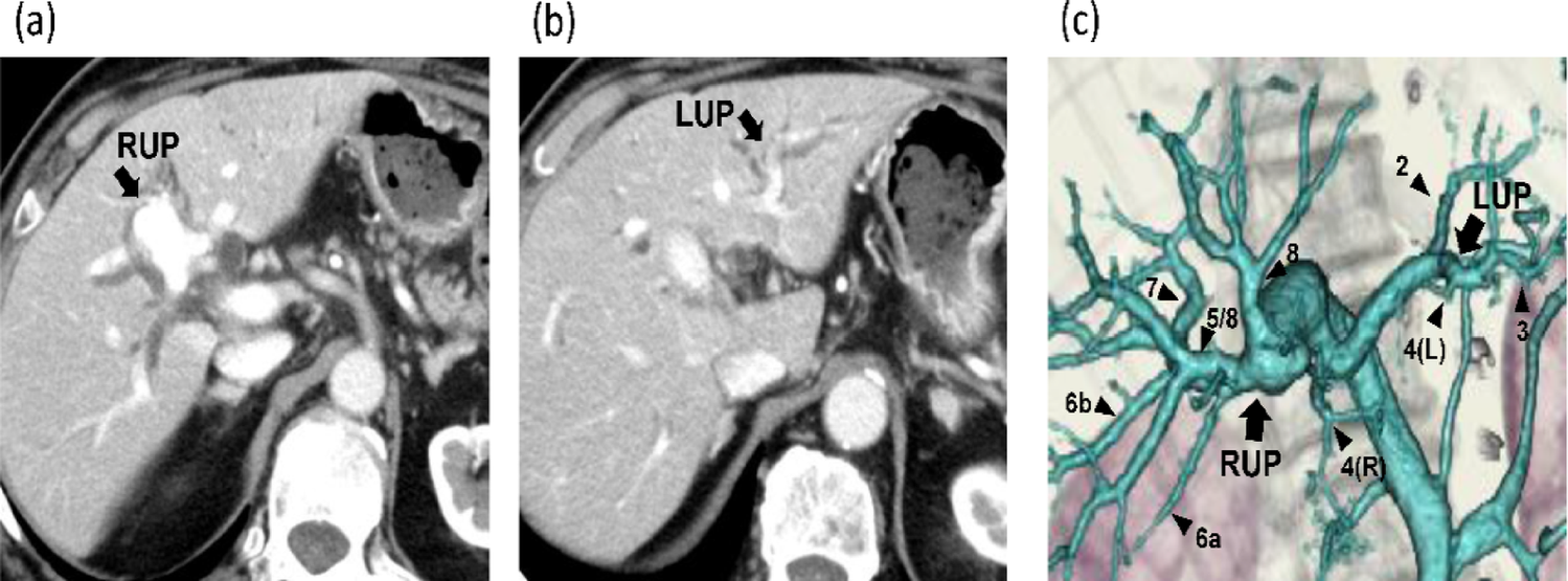 Bilateral umbilical portions of the portal vein with paired ligamenta teres converging into a single falciform ligament: an anatomic variation with surgical implications