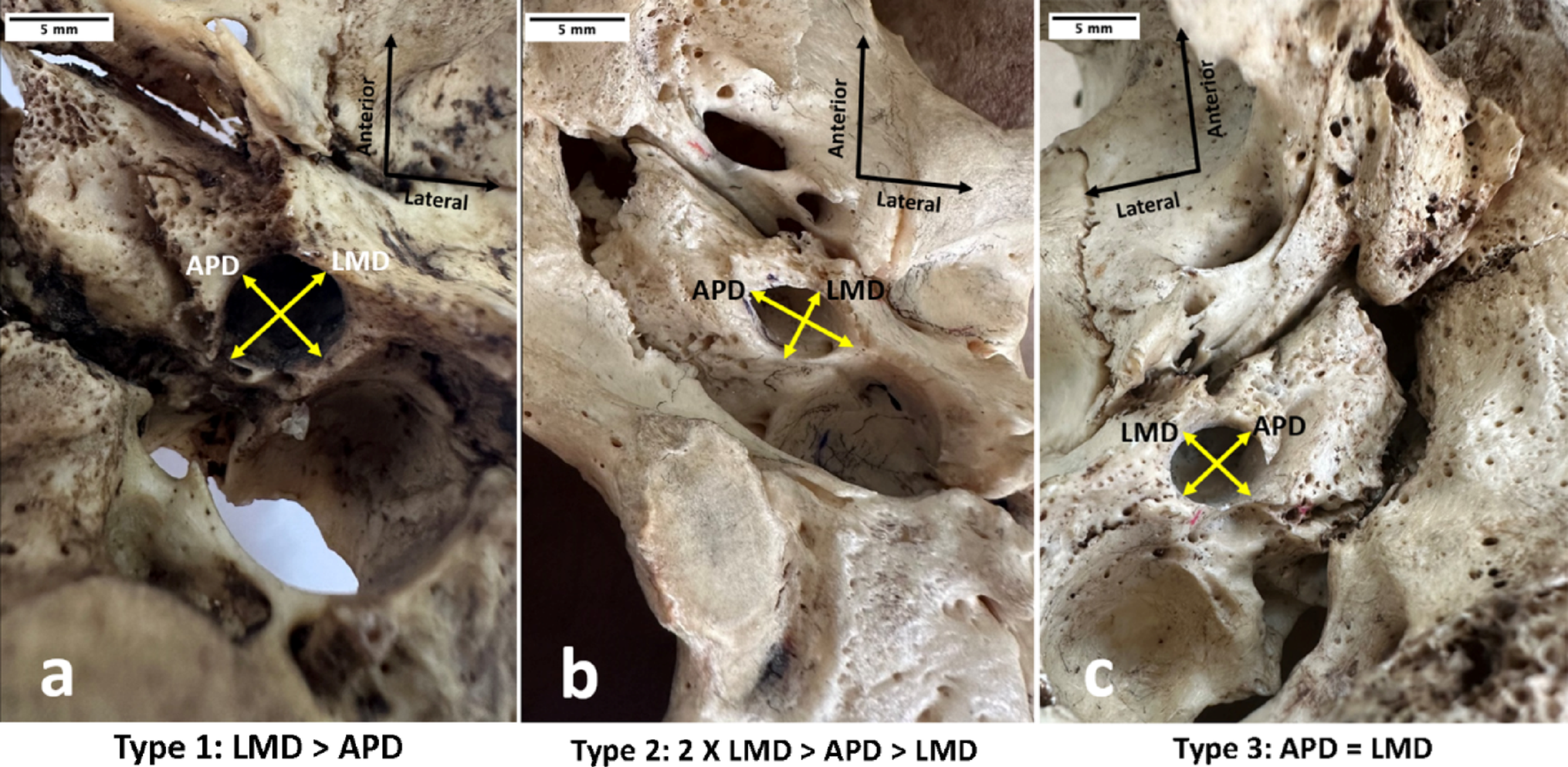 Morphometric evaluation of the external opening of the carotid canal and its relationships with adjacent skull base landmarks