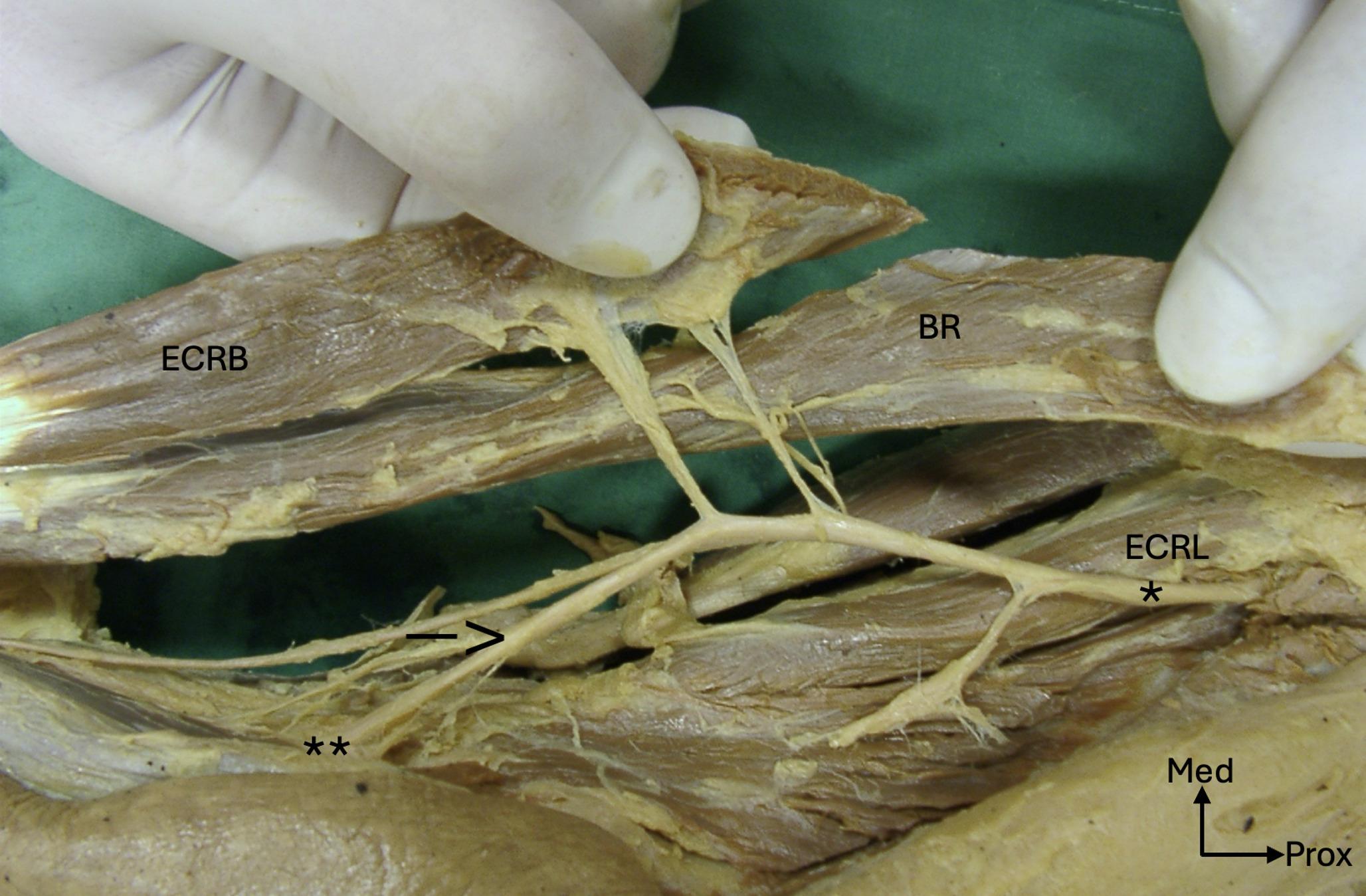 Anatomical basis of the neurotization of the brachialis muscle to the extensor carpi radialis muscles to restore an active extension of the tetraplegic wrist