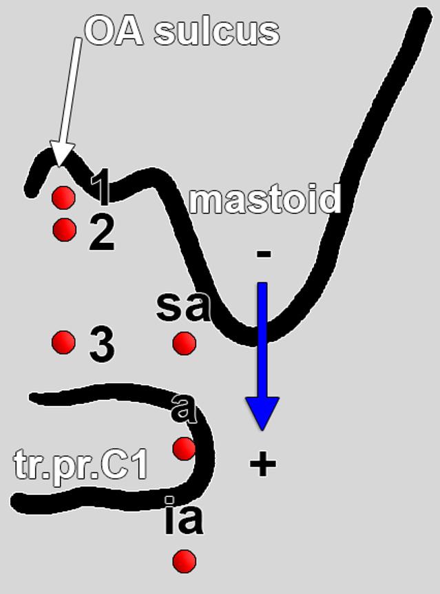 CTA-based classification of occipital artery course variations at the atlanto-occipital interval, with surgical implications