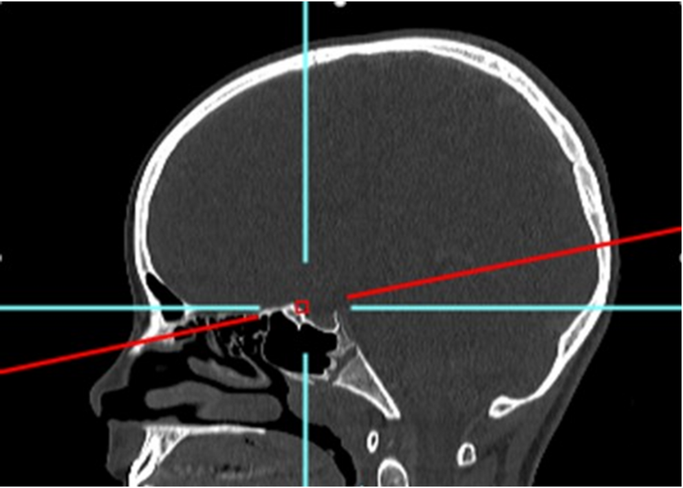 Normative data for interorbital distance in a paediatric Caucasian population