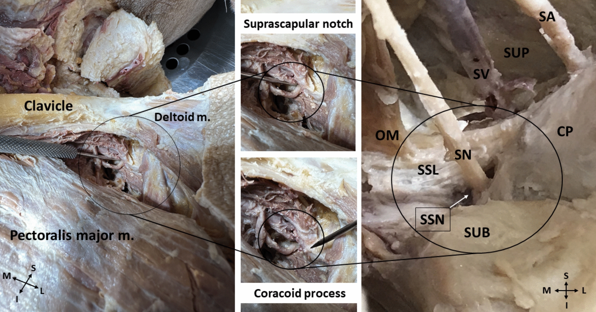 Sonographic visualization of the suprascapular canal with focus on the suprascapular notch: anatomical description and ultrasound-probe techniques