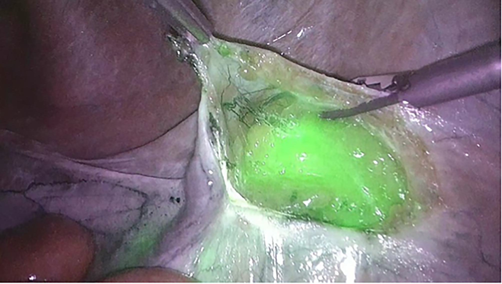 Improved outcomes of fluorescence-guided laparoscopic lymph node biopsy vs. conventional laparoscopic technique in lymphoma diagnosis