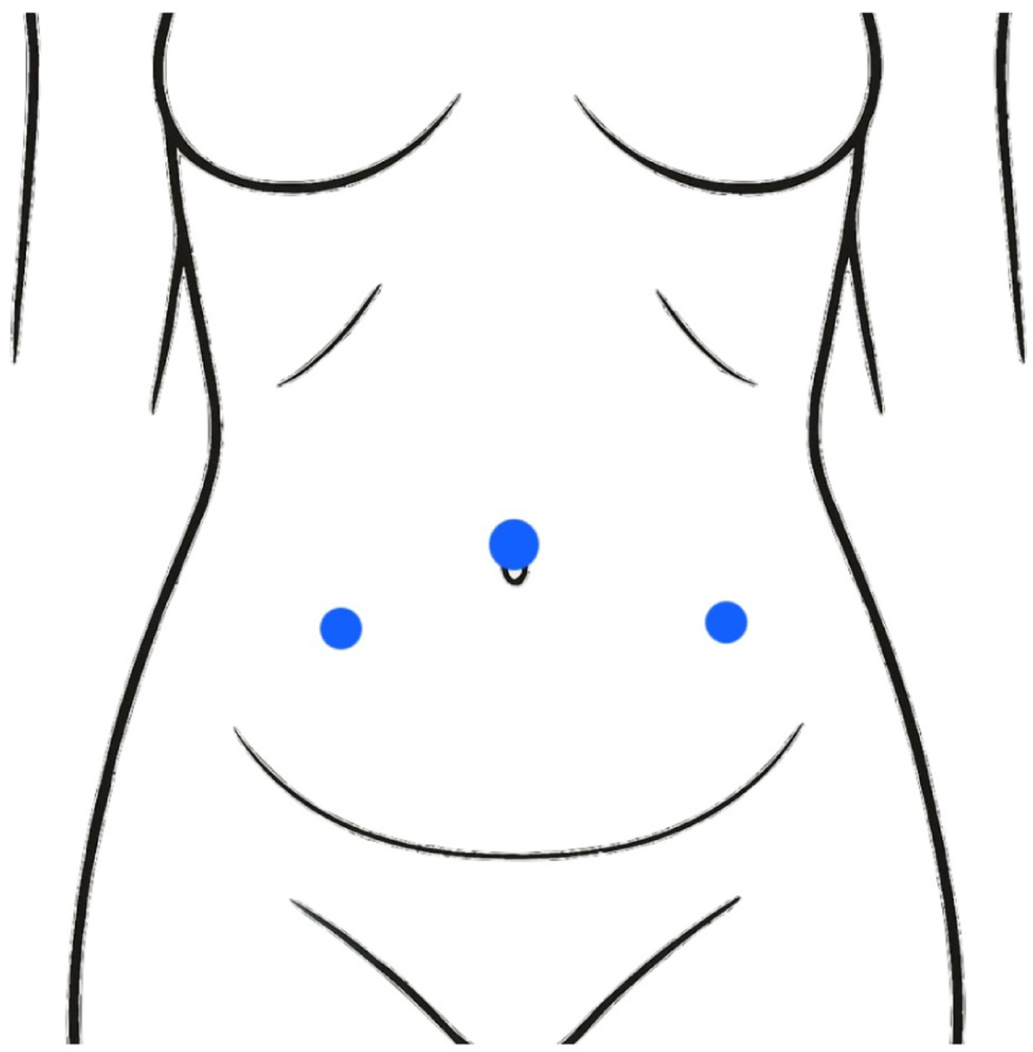 Safety of non-absorbable tack fixation in laparoscopic ventral rectopexy for external and high-grade internal rectal prolapse: early outcomes from a single-centre cohort