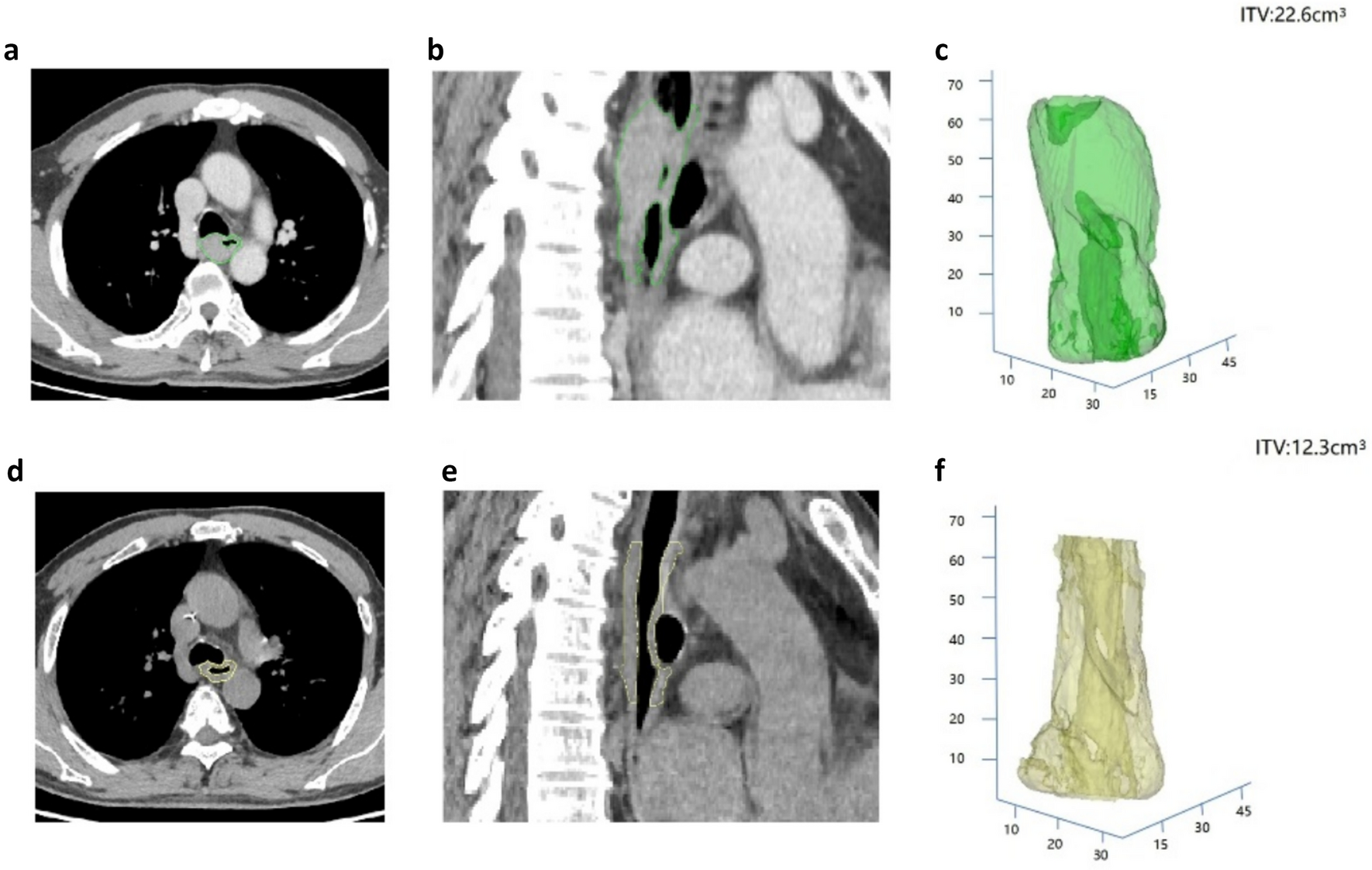 CT imaging is a feasible method for the preoperative prediction of the main pathologic response after neoadjuvant therapy for locally advanced esophageal squamous cell carcinoma