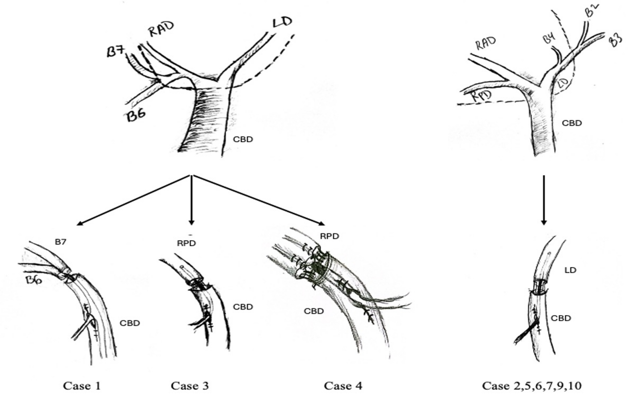 Duct to duct biliary reconstruction during major hepatectomy with limited resection of the biliary confluence