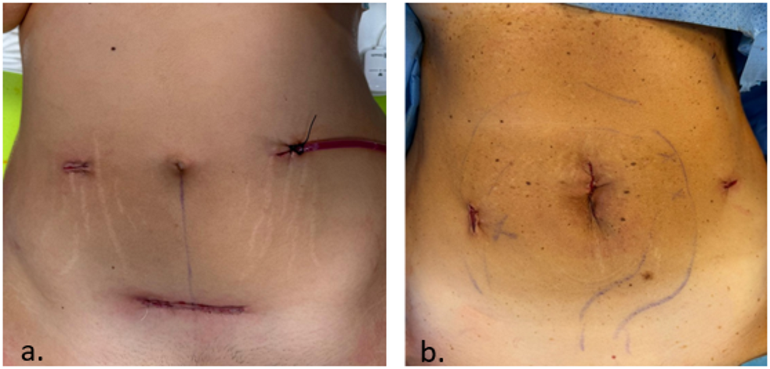 Single-port robotic total colectomy: technical standardisation and ergonomic considerations of suprapubic versus periumbilical access