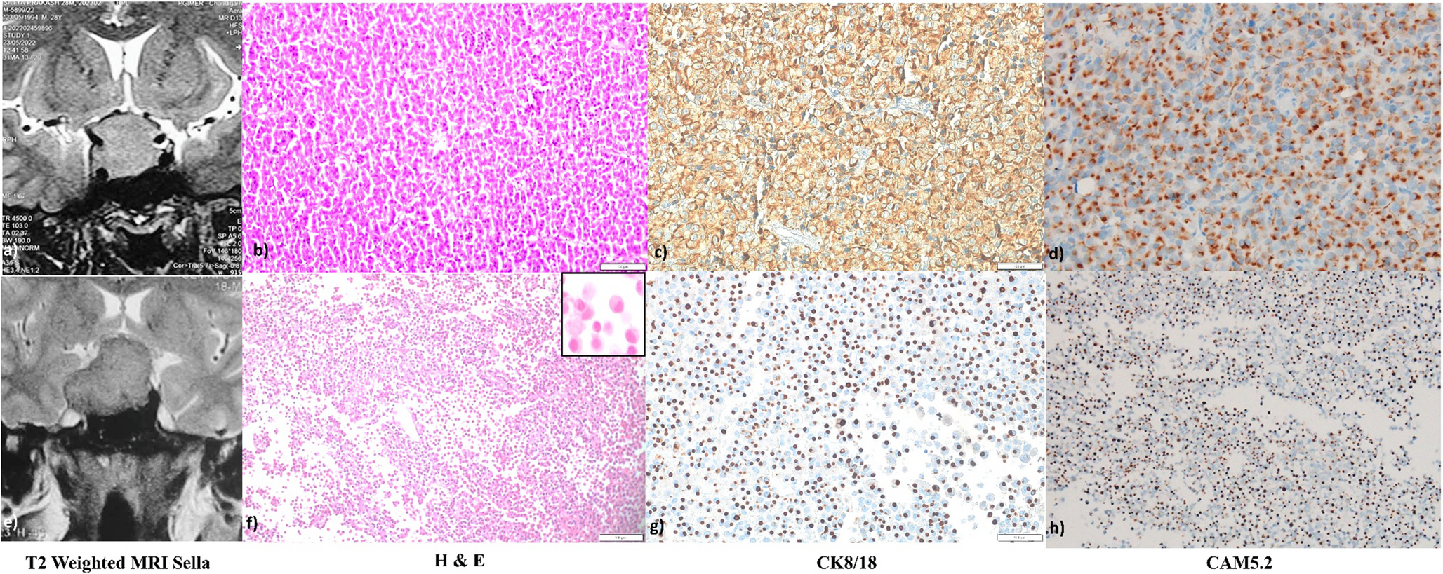 Cytokeratin 5.2 expression as a predictive marker of outcome in patients with acromegaly following endoscopic transsphenoidal surgery