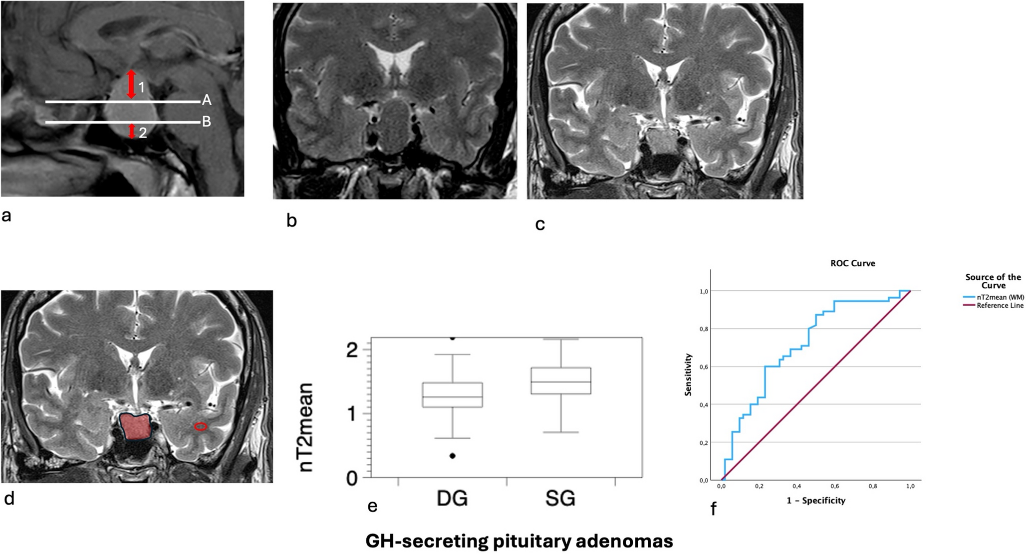 Histopathological and radiological predictors of surgical remission failure in GH-secreting pituitary adenomas