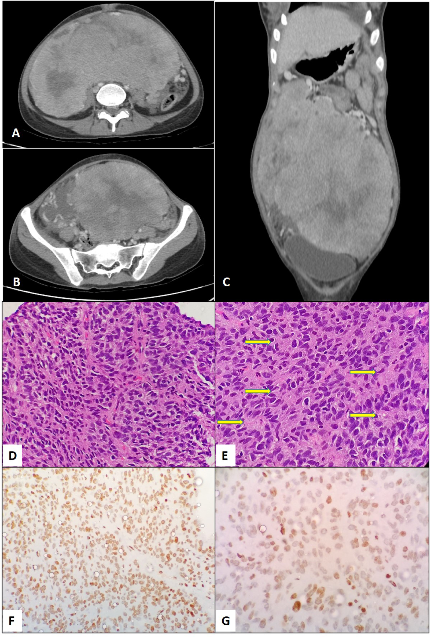A Rare Case of Follicular Dendritic Cell Sarcoma Masquerading as Ovarian Sex Cord Stromal Tumor