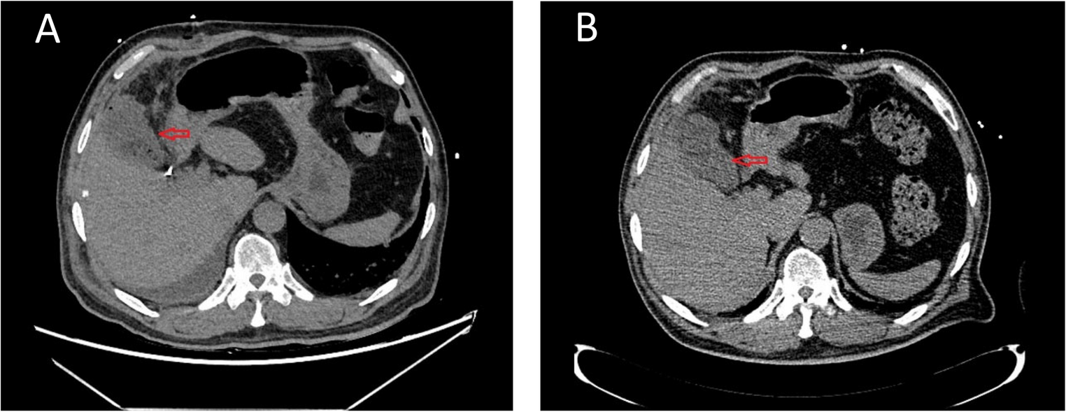 Acute cholecystitis complicated with hepatic abscess caused by rare heterogeneous mucoid  Enteritidis: case report and literature review
