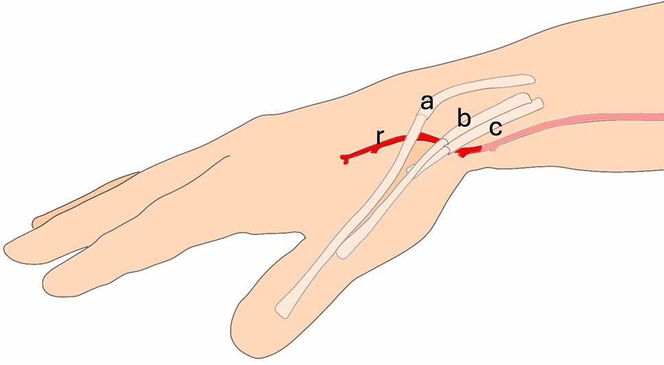 Efficacy of catheterization of the distal radial artery in blood pressure monitoring and blood sampling: a randomized controlled clinical study