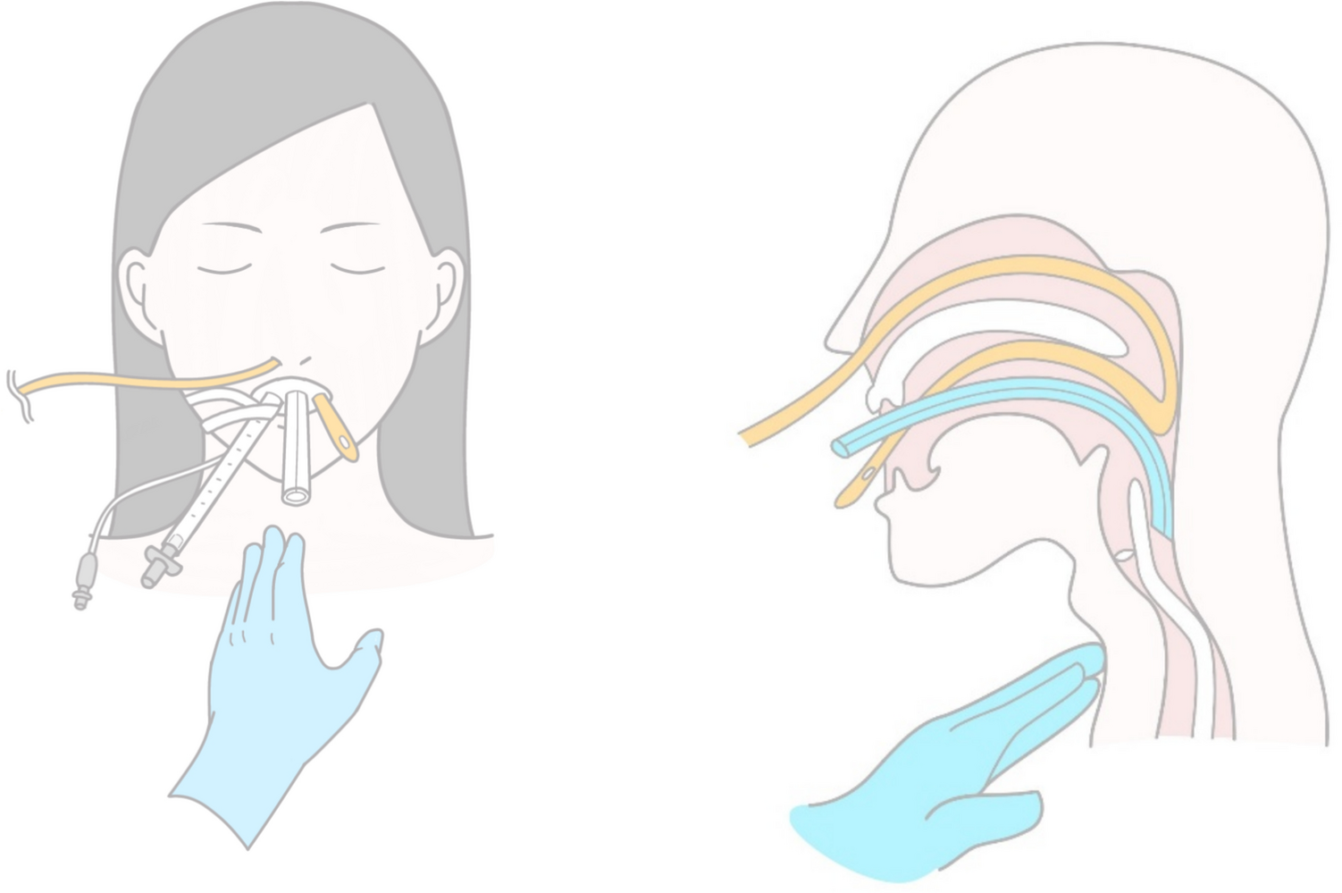 Combination of a gastric tube insertion guide and cricoid pressure