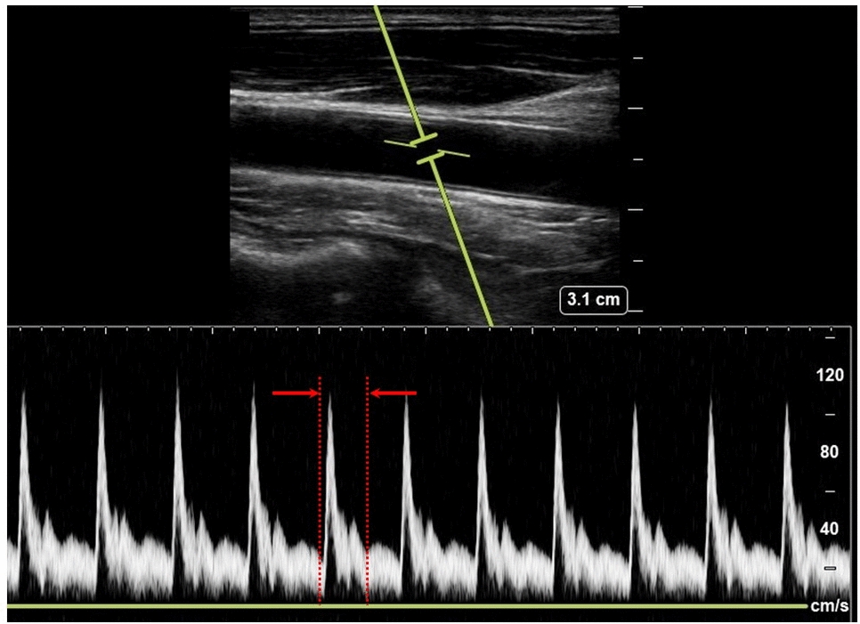 Carotid flow time: a new surrogate for fluid responsiveness?