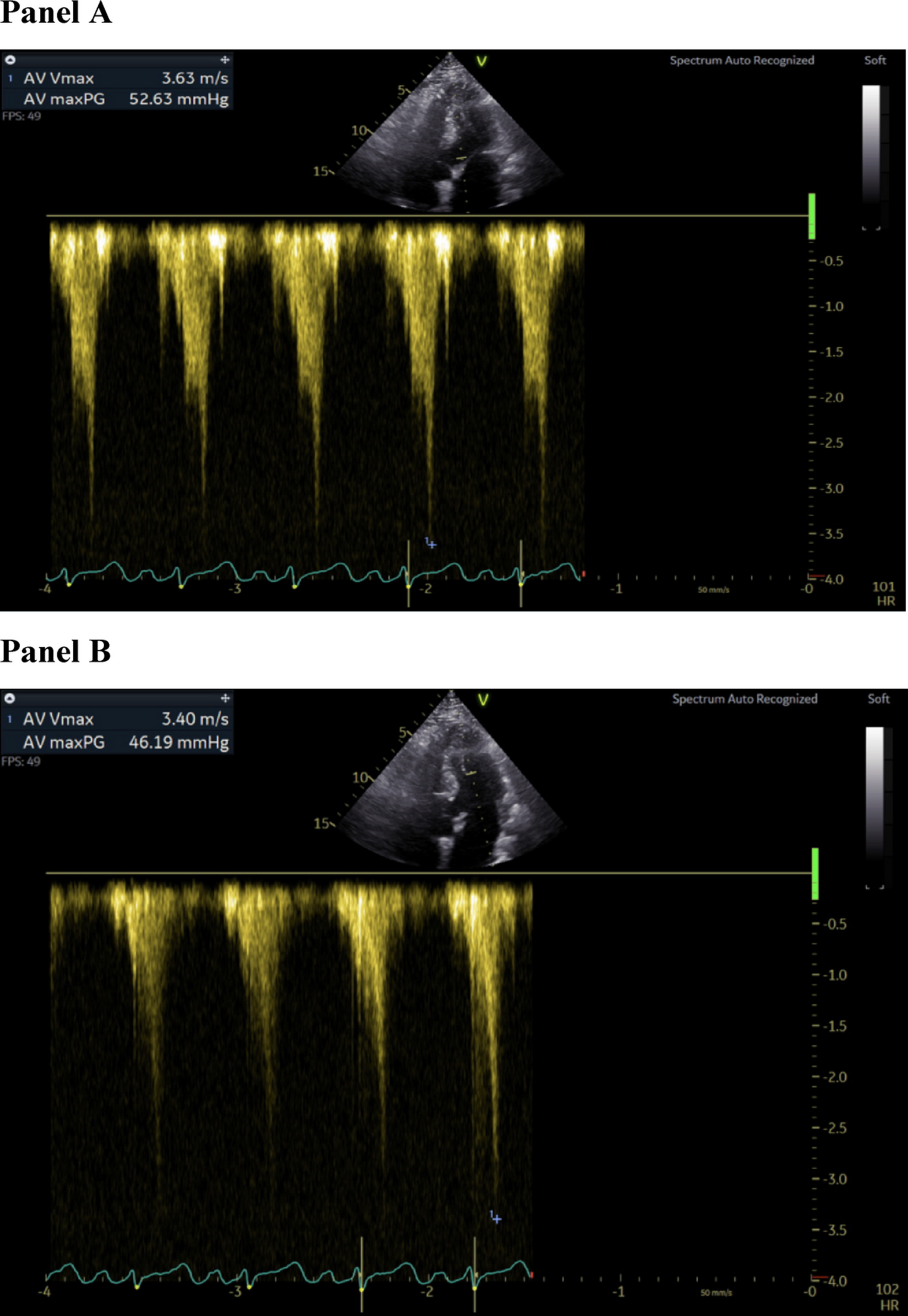 Predictors and prognostic impact of dynamic left ventricular outflow tract obstruction during dobutamine stress echocardiography