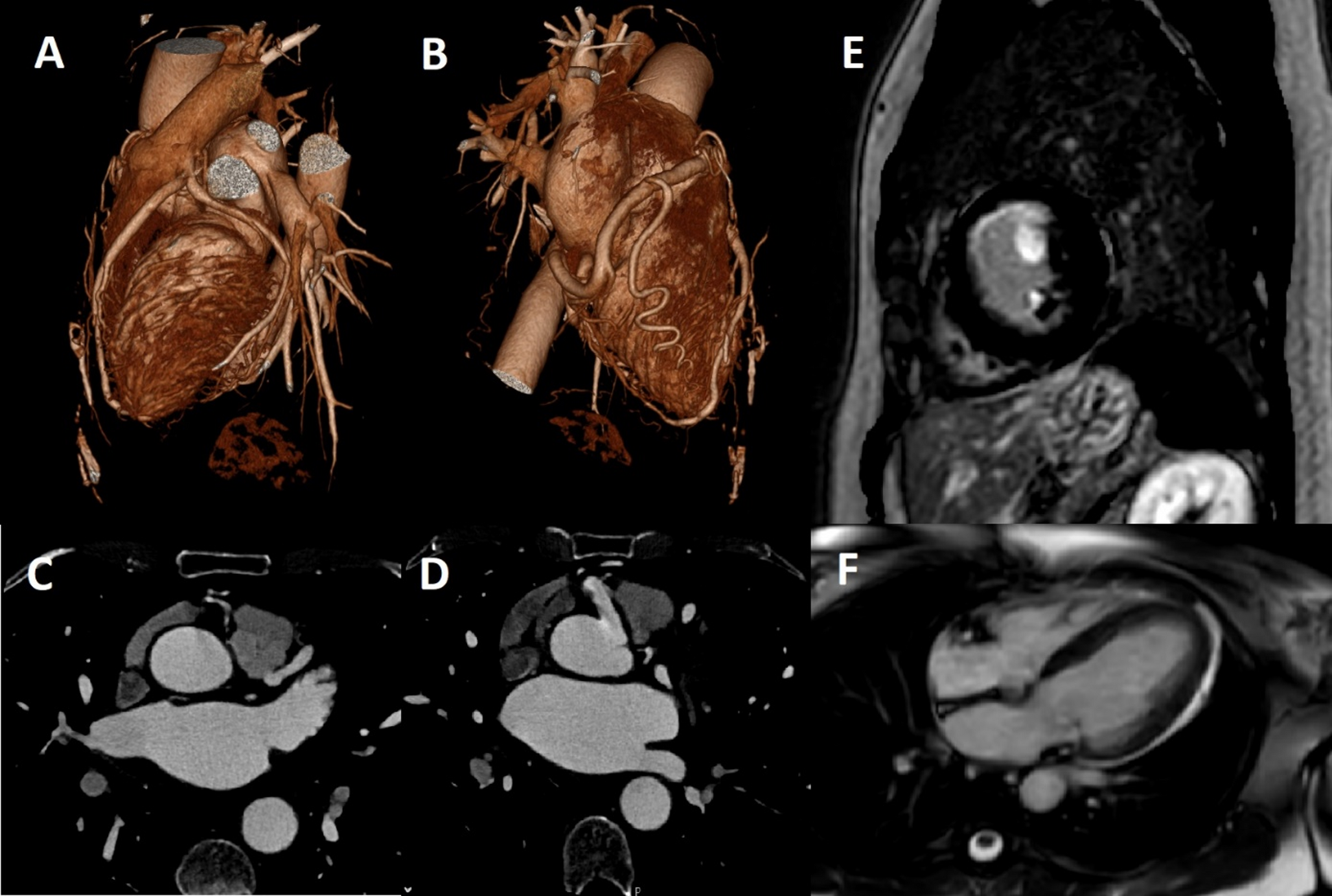 ALCAPA: Multimodality imaging findings in an adult patient