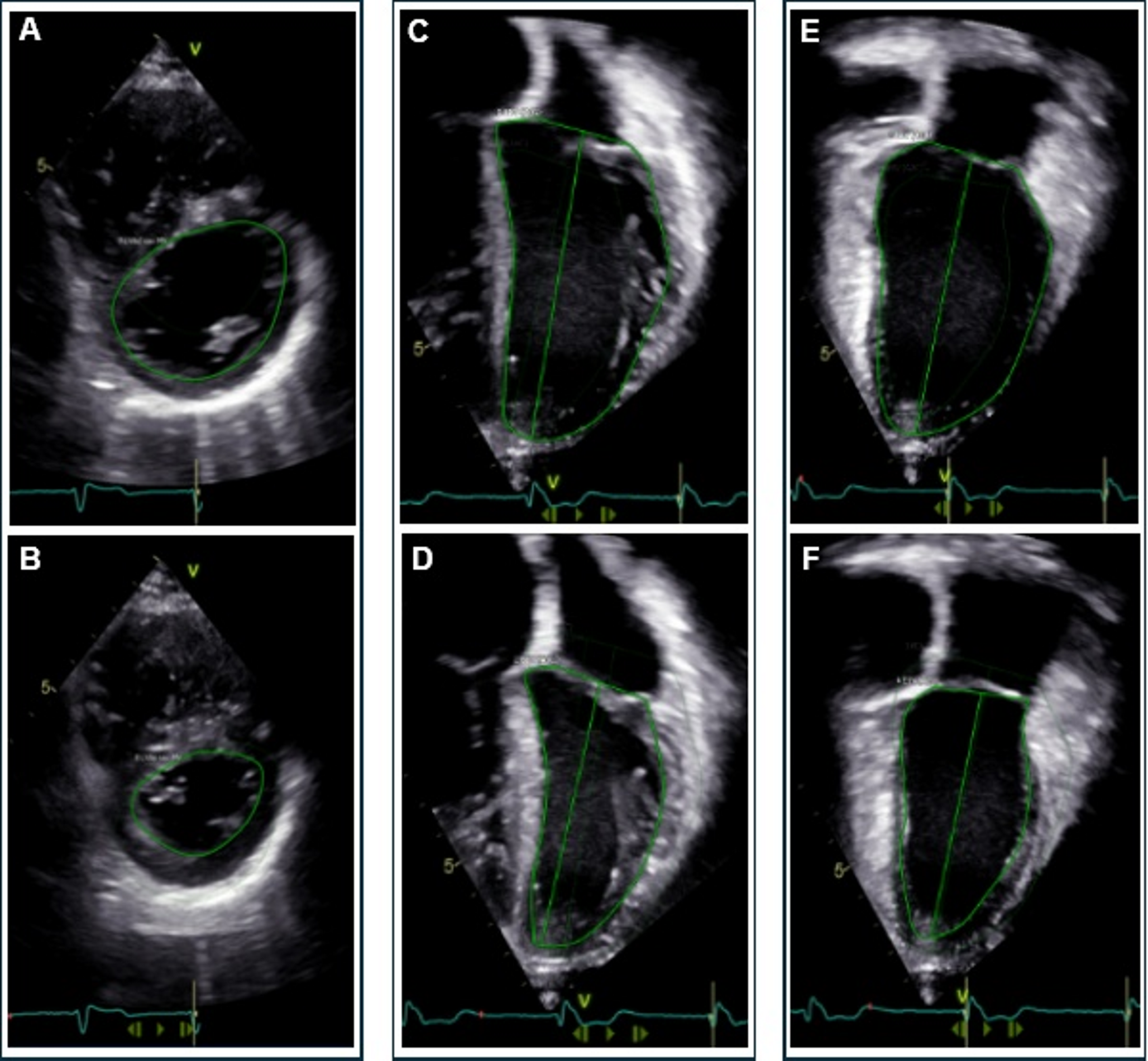 Left ventricular quantification in repaired tetralogy of Fallot: two-dimensional echocardiography versus cardiovascular magnetic resonance