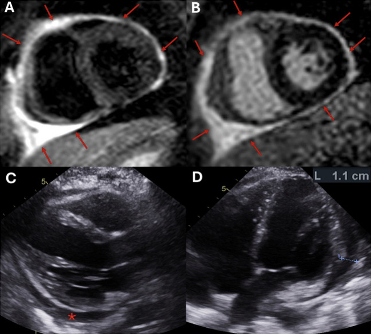 Infliximab-induced lupus with recurrent pericarditis: longitudinal CMR assessment of inflammatory resolution