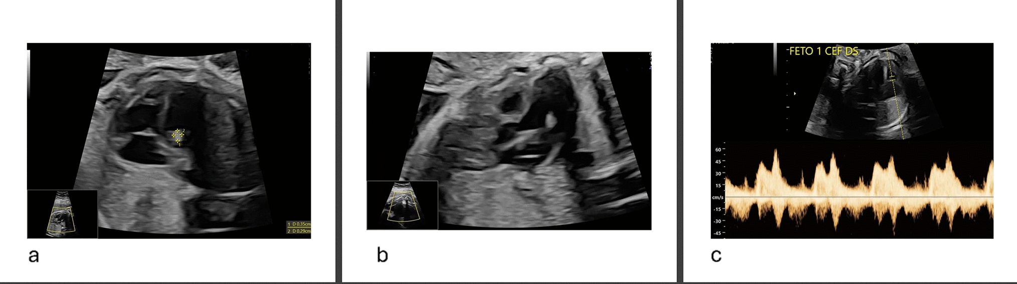 Foetal detection of a mitral leaflet mass