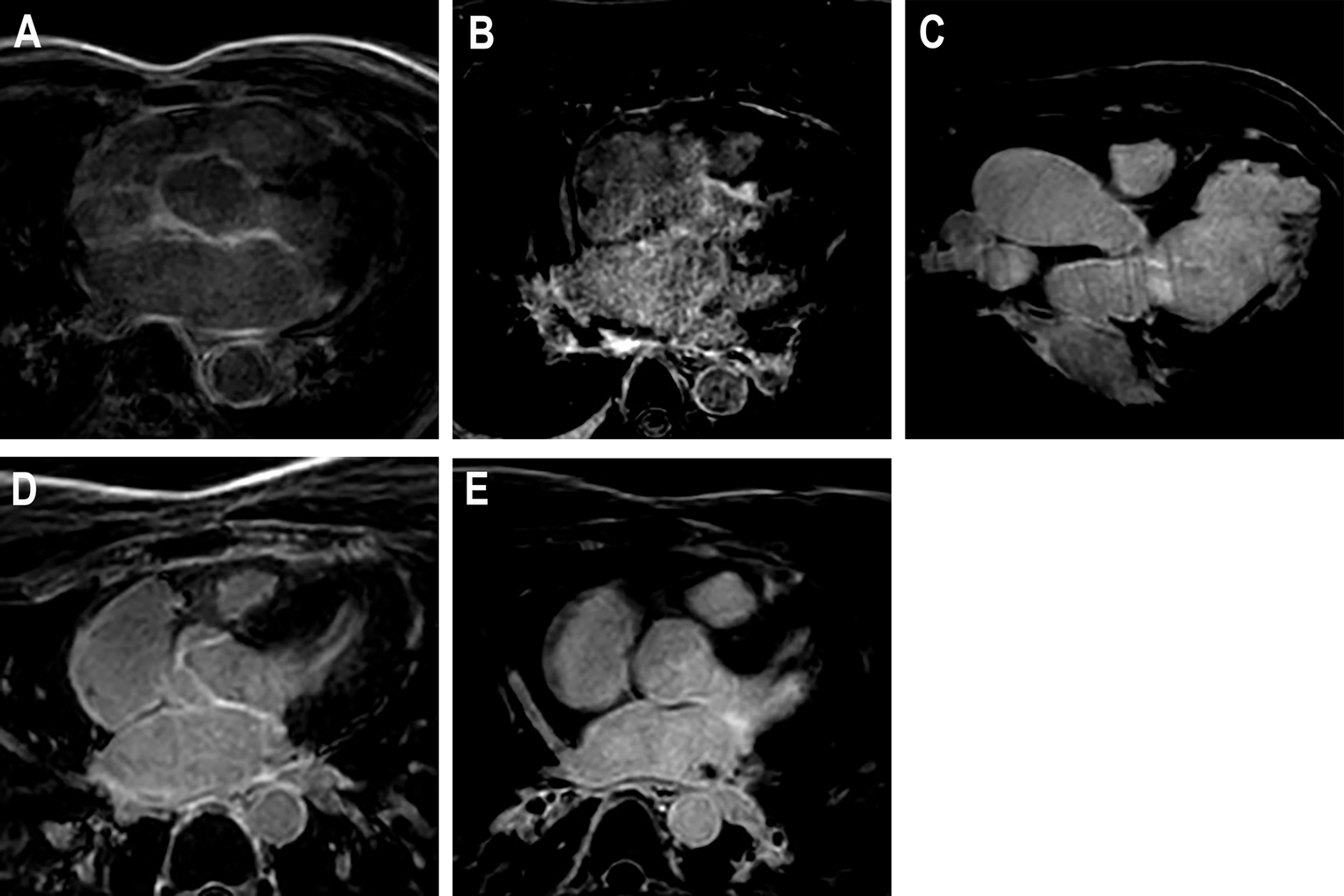 Quantitative detection of left atrial fibrosis in patients with atrial fibrillation: a comparative study of two 3D whole-heart late gadolinium enhancement sequences