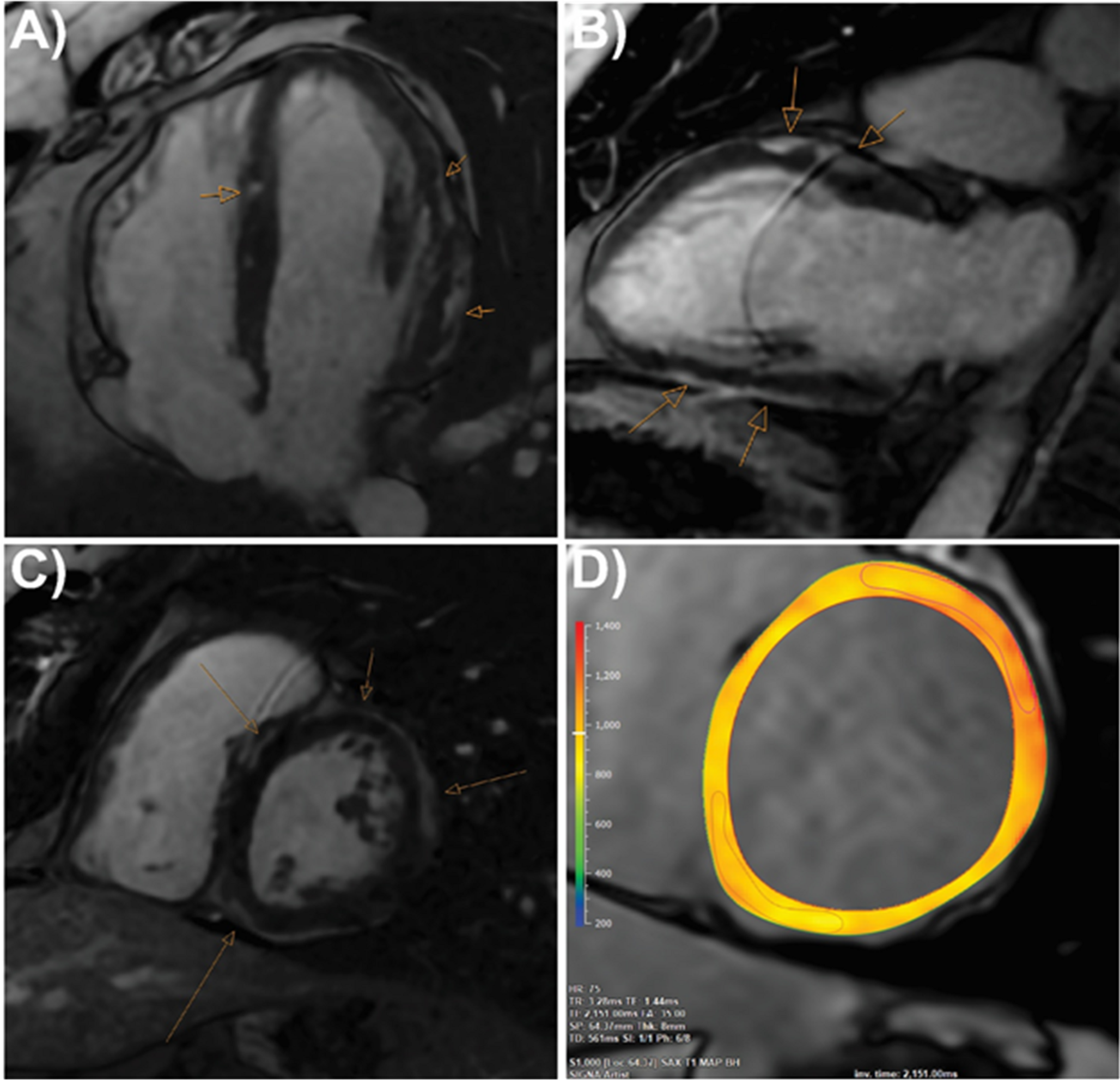 Desmoplakin Cardiomyopathy