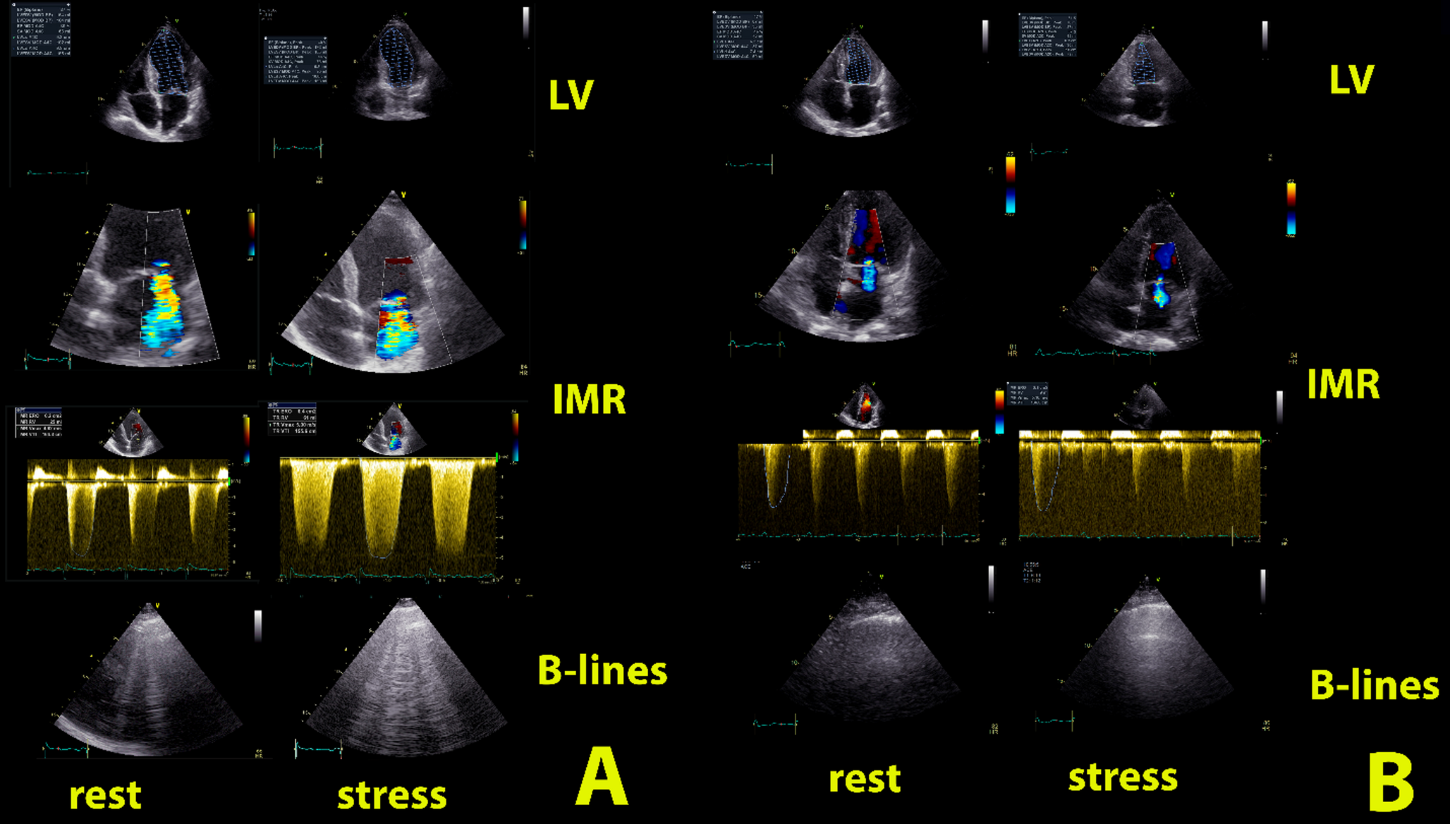 Moderate ischemic mitral regurgitation at rest is associated with multiple functional vulnerabilities during exercise stress echocardiography