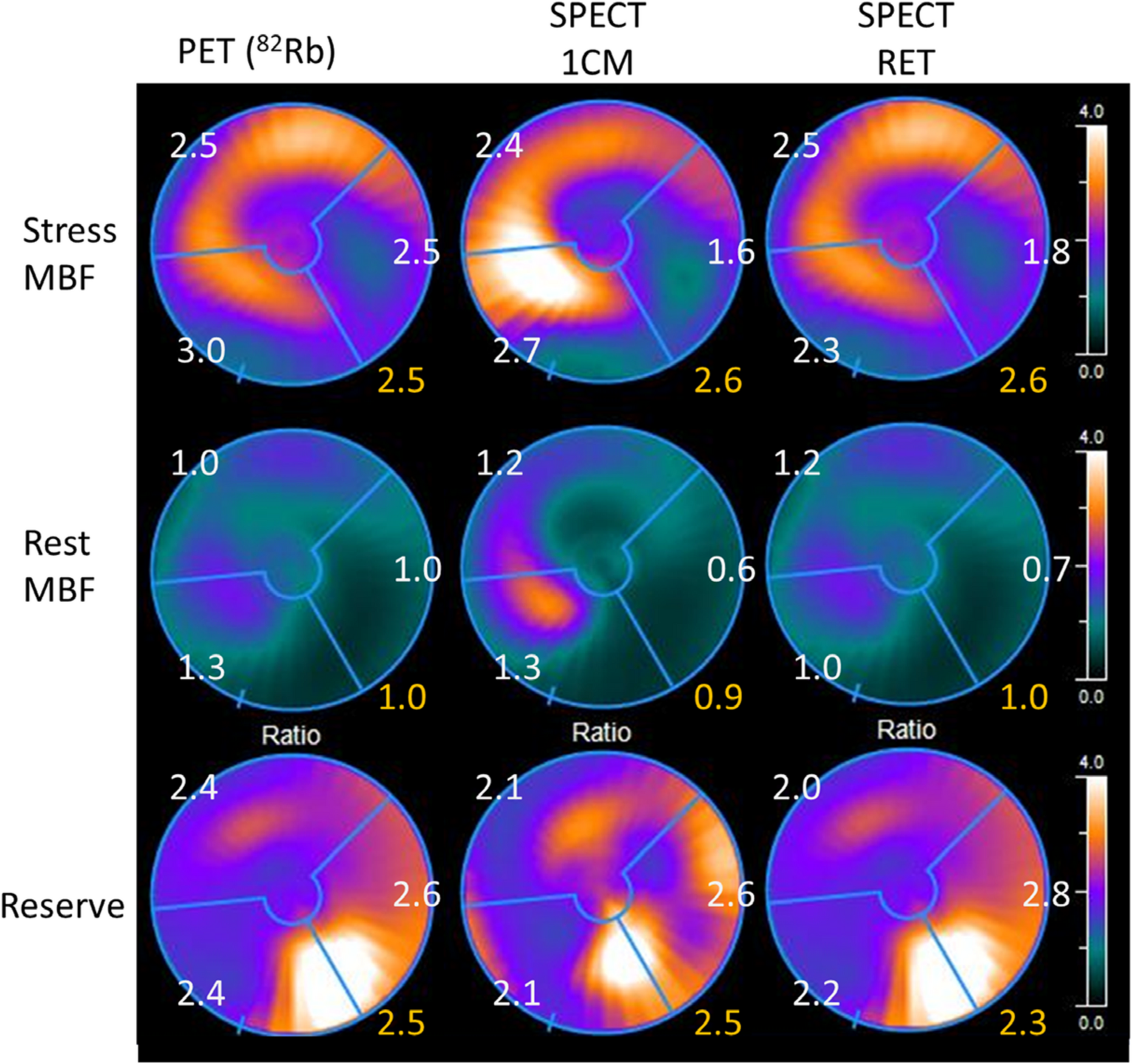 Feasibility of Quantitative Myocardial Perfusion with CZT SPECT and SPECT/CT: Current Limitations and Recommendations for Future Improvements