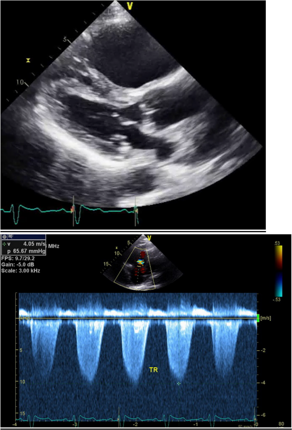 Echocardiography in HIV Disease