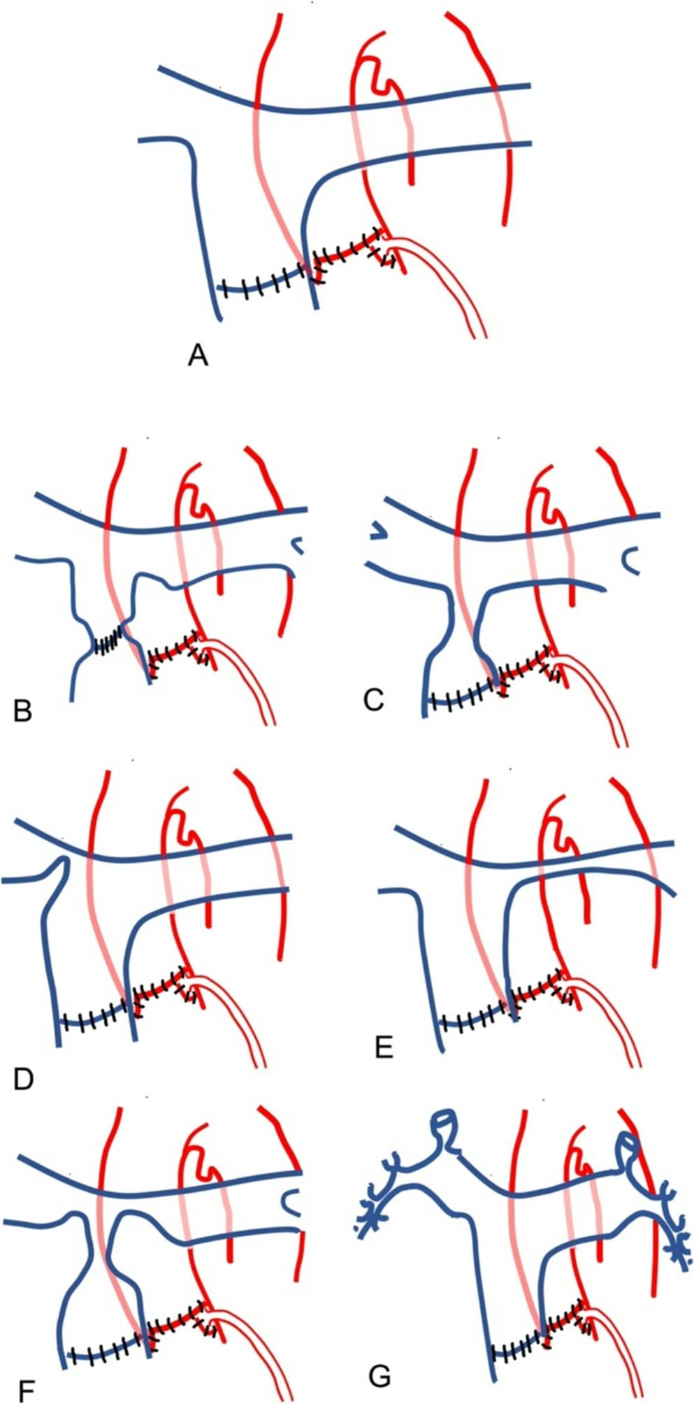 Interventional Strategies for Pulmonary Artery Stenosis After the Arterial Switch Operation
