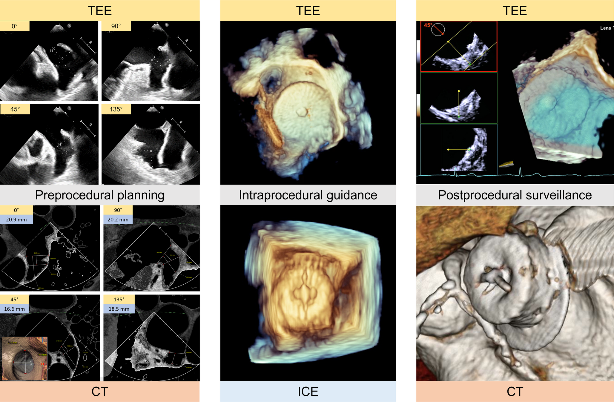 Multimodality Imaging for Left Atrial Appendage Occlusion Devices