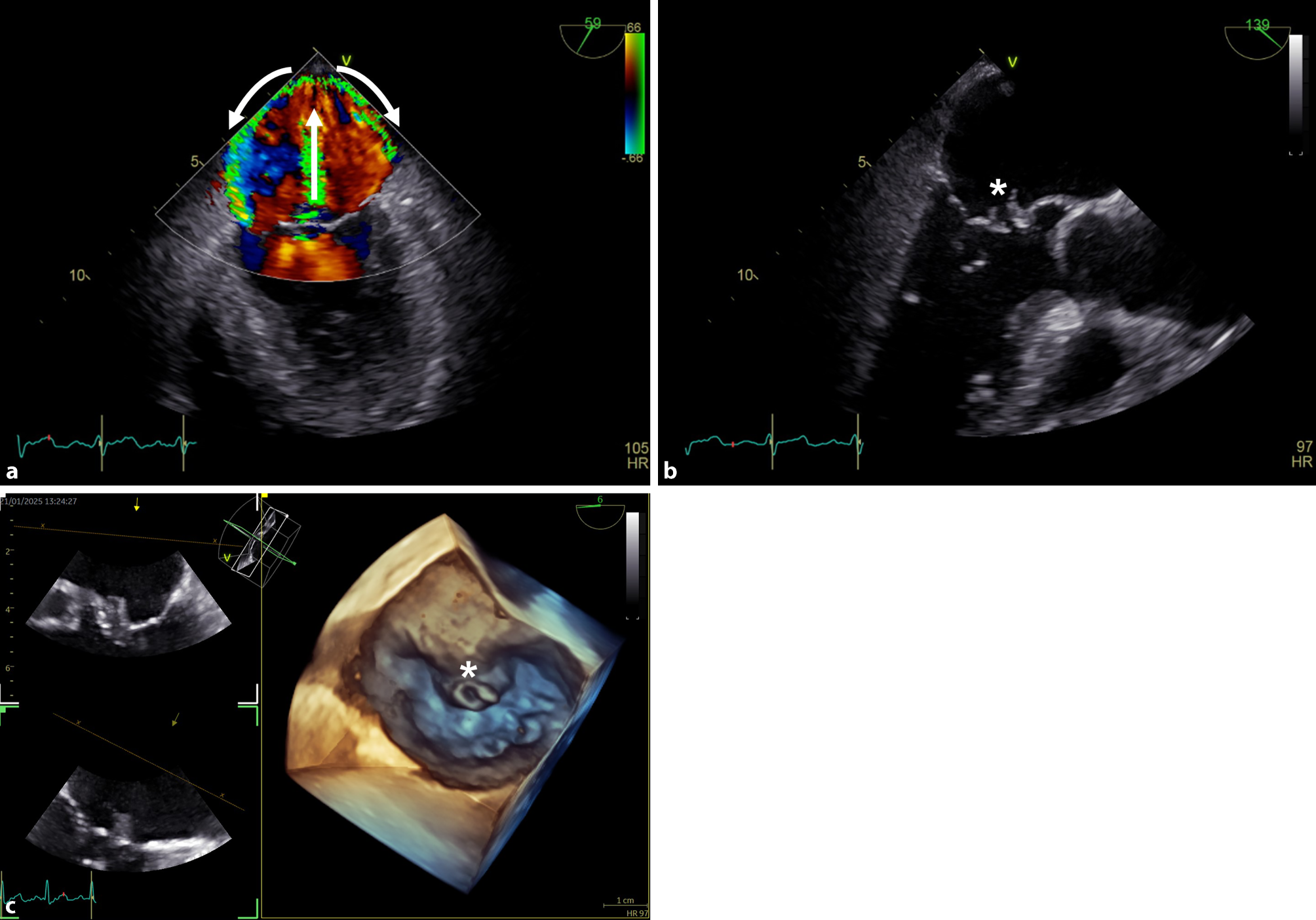 Severe mitral regurgitation with bidirectional Coanda effect
