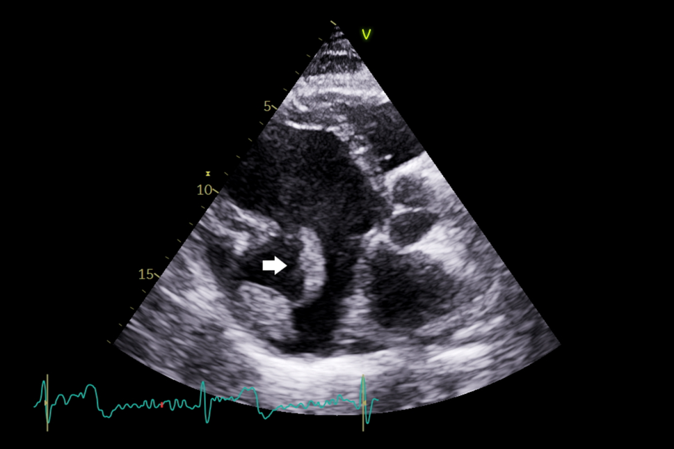 A matter of time: Cardiac aneurysm and recurrent thromboembolic events