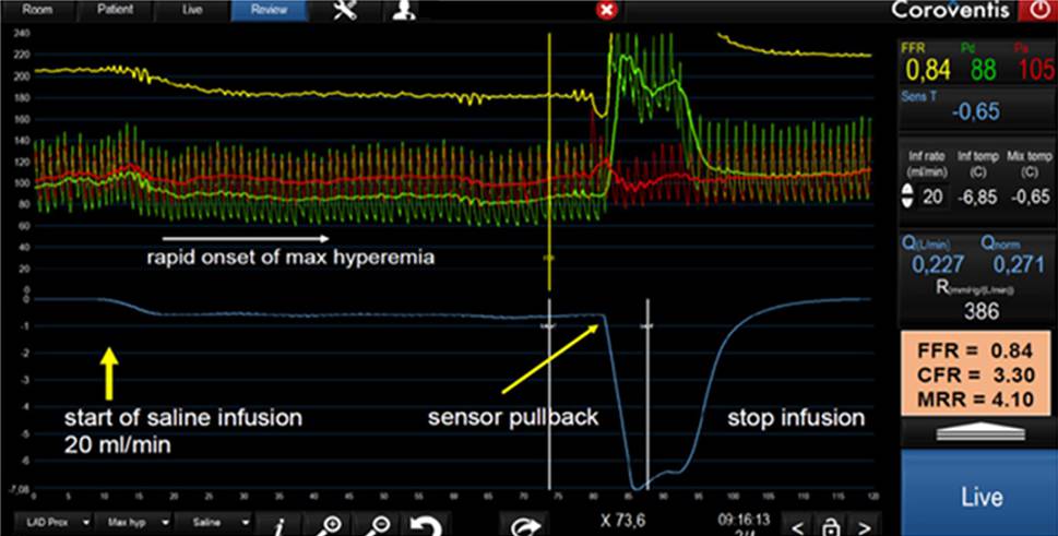 Microvascular Resistance Reserve (MRR): a new concept to understand the coronary microcirculation