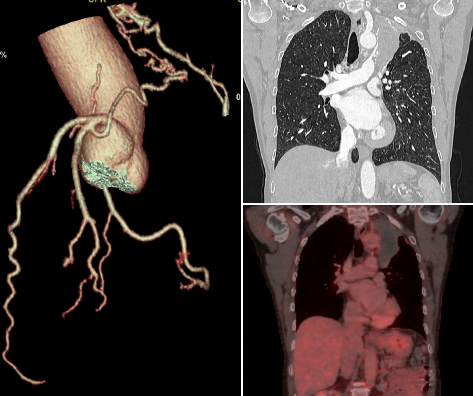 A curious coronary pulmonary communication: What lies beneath?