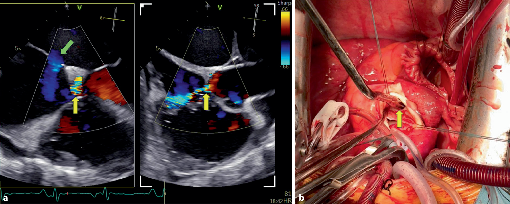Understanding an aorto-atrial fistula in a patient with heart failure