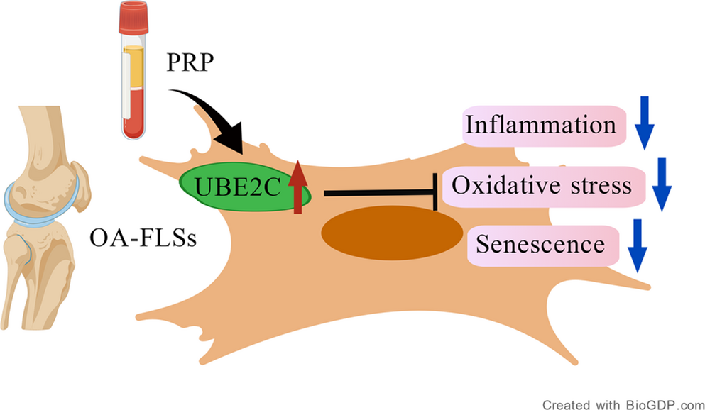 Mechanism of platelet-rich plasma inhibiting inflammatory response, oxidative stress, and senescence in synovial fibroblasts of patients with knee osteoarthritis via  based on transcriptome sequencing analysis