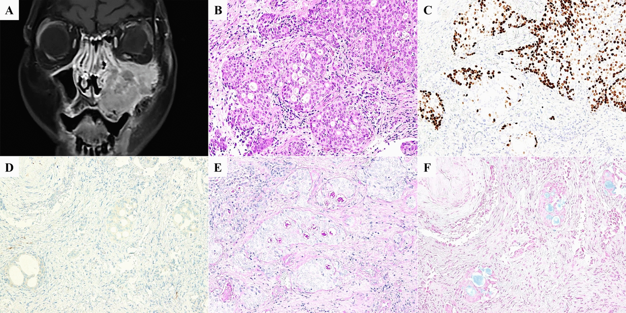 Establishment and characterization of a novel sinonasal adenosquamous carcinoma cell line, TC717, with a high tumor mutational burden