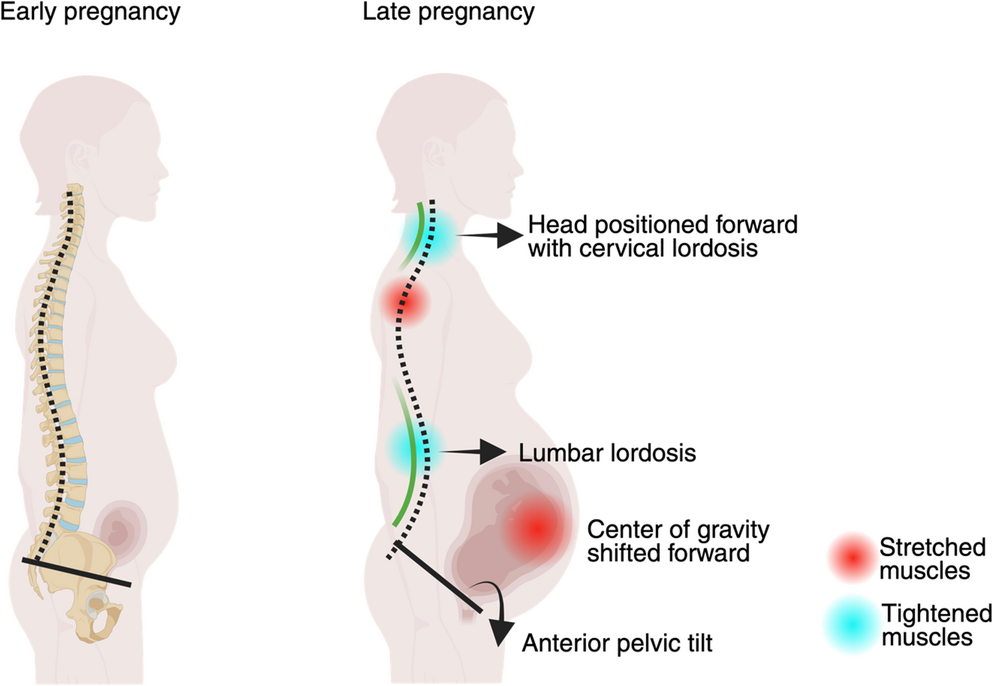 Epidemiology, Risk Factors, and Management of Pregnancy-Related Chronic Back Pain