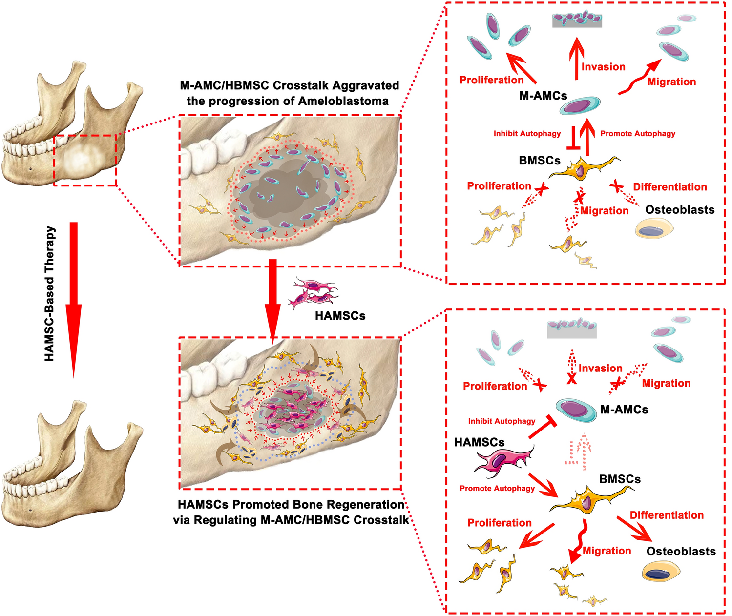 Human Amniotic Mesenchymal Stromal Cells Promote Bone Regeneration via Regulating Ameloblastoma-Derived-Bone Marrow Mesenchymal Cells Crosstalk and Autophagy in Ameloblastoma Microenvironment
